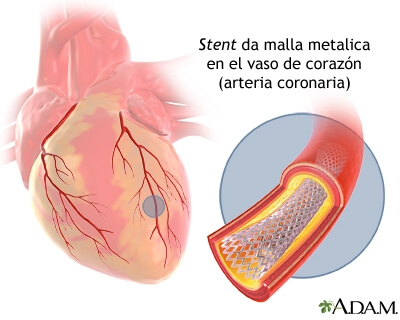 Angioplastia y colocación de stent en el corazón