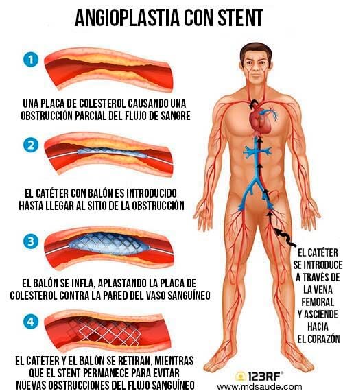 Cateterismo Cardíaco – Angioplastia con Stent